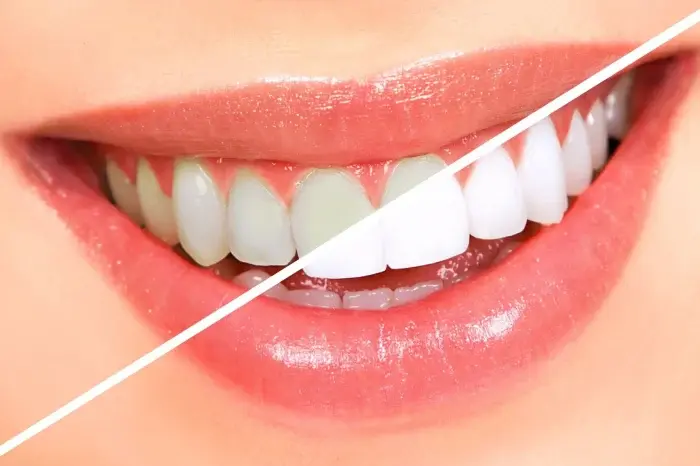Teeth Whitening Reviews