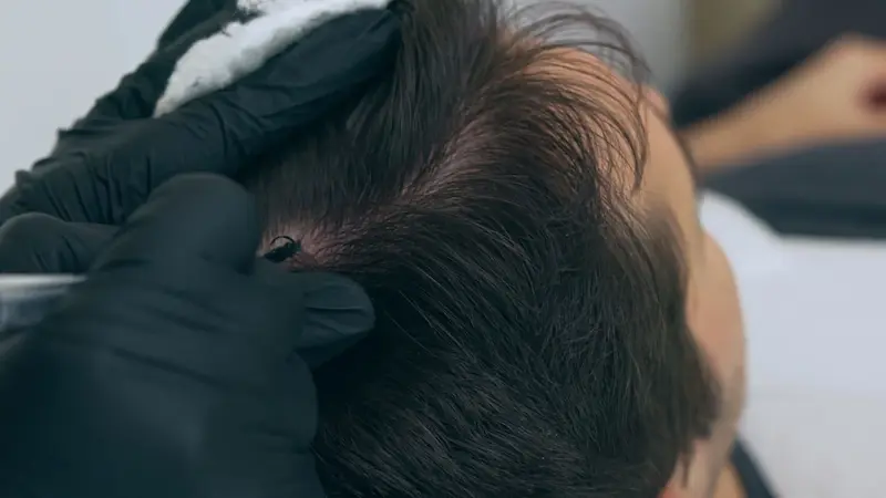 Understanding Hairline Tattoos