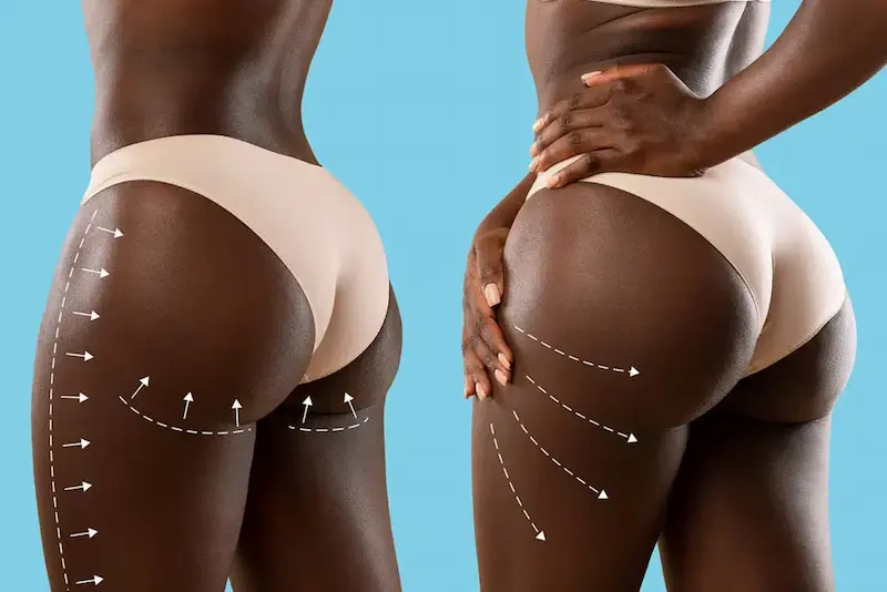 Brazilian Butt Lift Cost