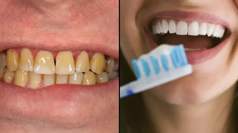 Yellow Teeth Causes
