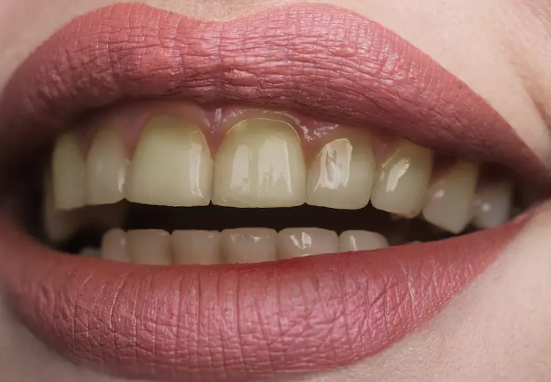 Yellow Teeth Even Though I Brush Every Day