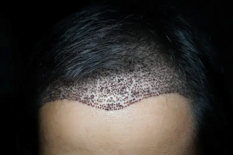 Hair Transplant Healing Time