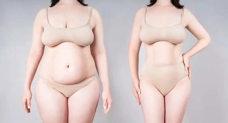 Sleeve Gastrectomy Turkey