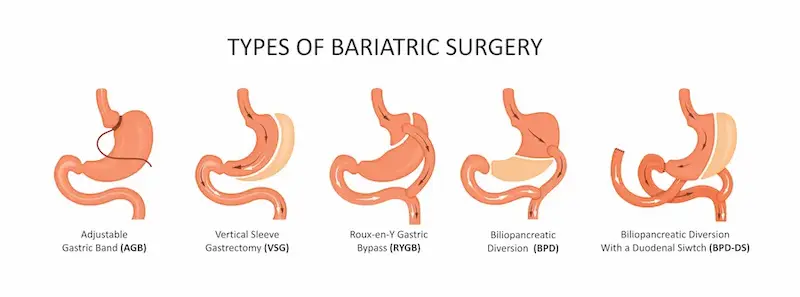 Types Of Bariatric Surgery
