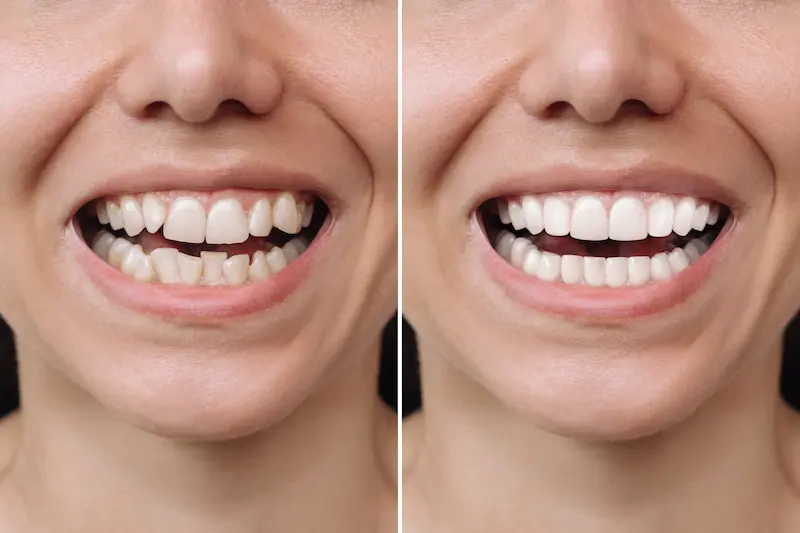 Hollywood Smile Before After