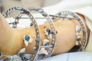 limb lengthening recovery